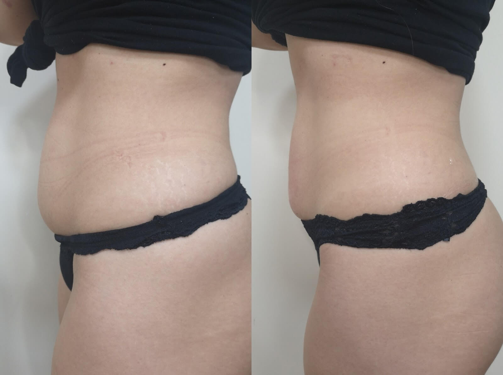 Non Surgical Fat Removal Bromley Charmelle London, 49% OFF